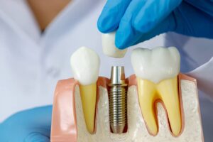 Everything You Should Know About Dental Implants