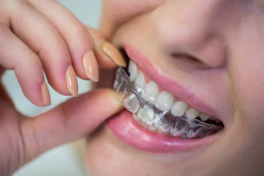 What to Expect from Your First Invisalign Appointment?